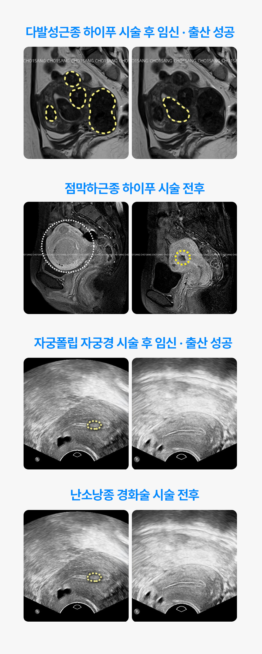 자궁근종